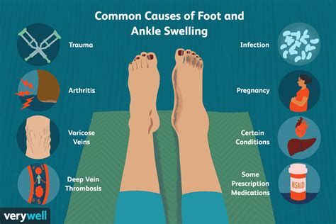 foothubnd|One Swollen Foot: Causes and Treatment Plans .